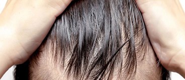 توضیحاتی در مورد روش کاشت موی اتوماتیک یا (SAFER)